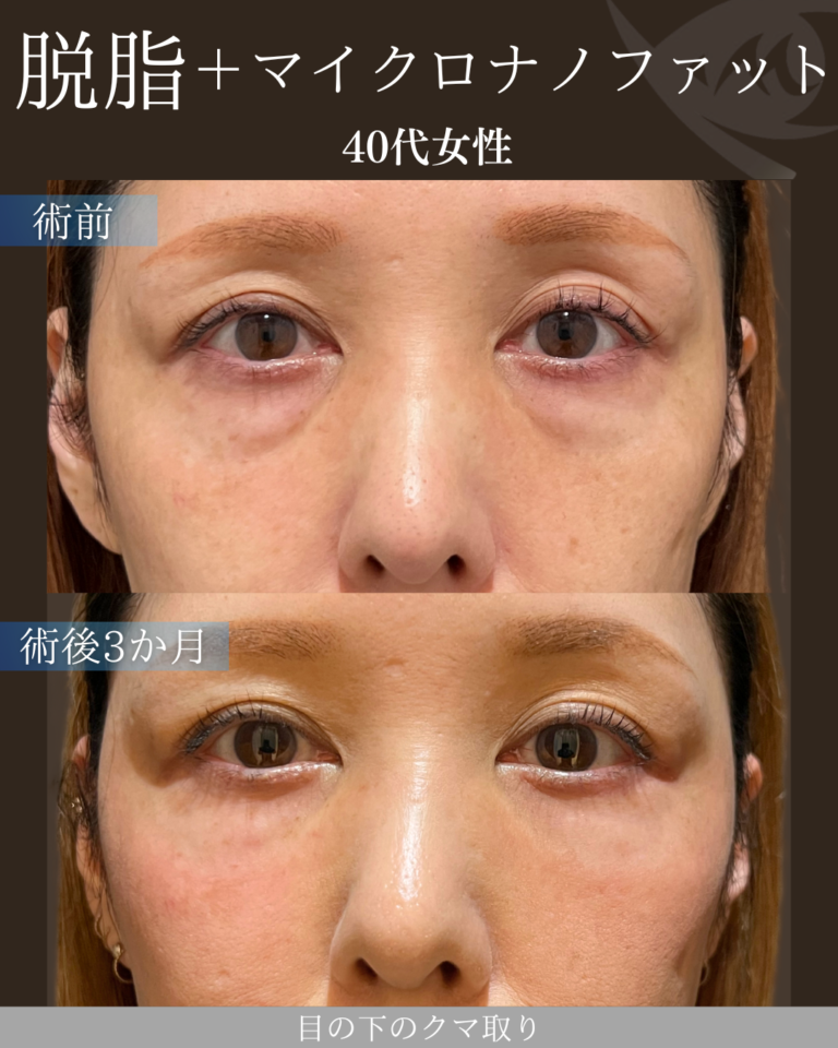 40代女性 脱脂+マイクロナノファット 3ヶ月後